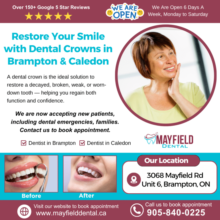 Dental crowns in brampton and caledon - Mayfield dental