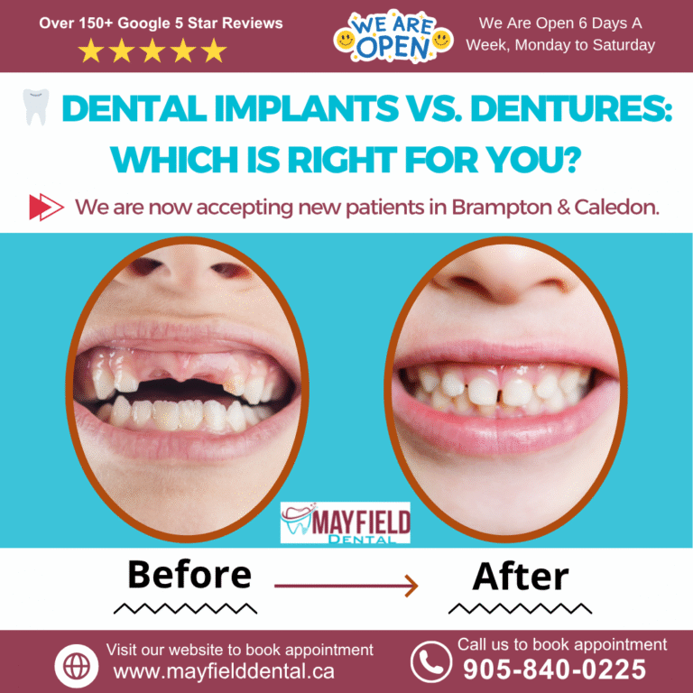 Mayfield dental - dental implants vs dentures