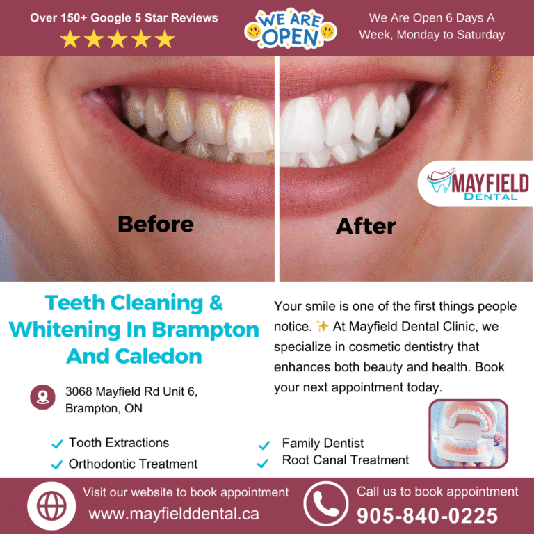 Teeth Cleaning and whitening in Brampton Ontario